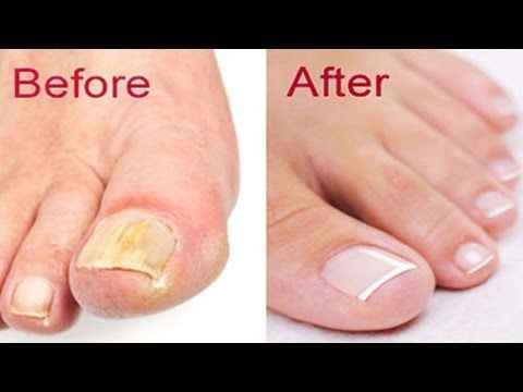 Find Best Nail Fungus Removal Oil for Your Care - SCENICBELLE